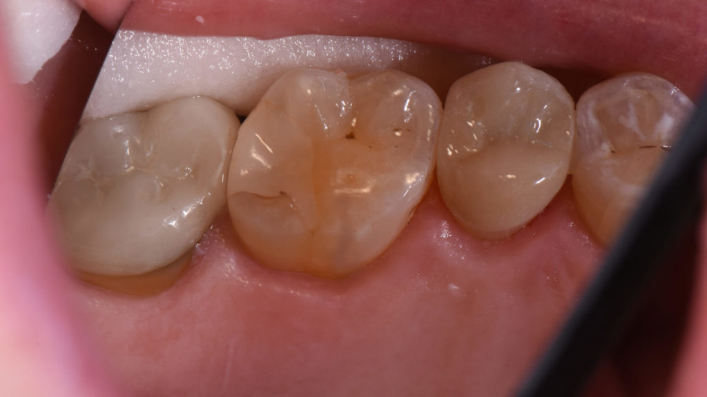 Cementing Crowns with Activa Bioactive Cement Oral Health Group Cementing Crowns with Activa Bioactive Cement Oral Health Group