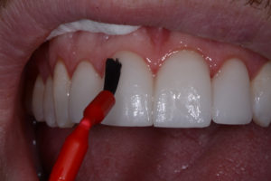 Try in paste with restorations.