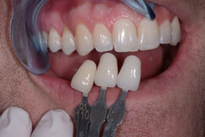 Shade Mapping post whitening, pre-prepping.