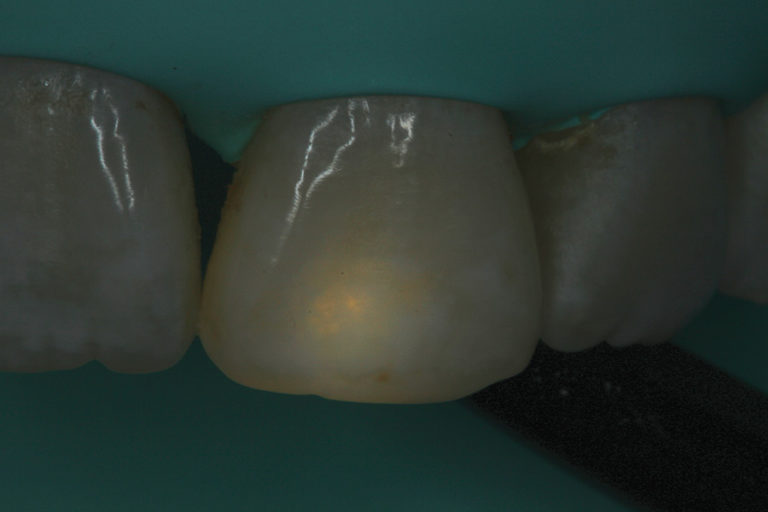 Resin Infiltration as Treatment for an Anterior Tooth Discoloration of