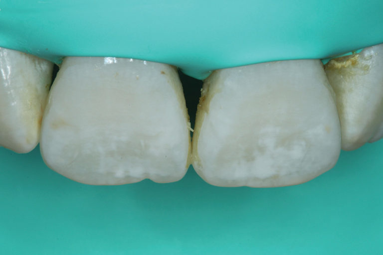 Resin Infiltration as Treatment for an Anterior Tooth Discoloration of