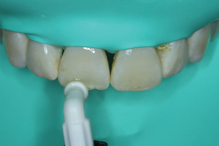 Resin Infiltration as Treatment for an Anterior Tooth Discoloration of