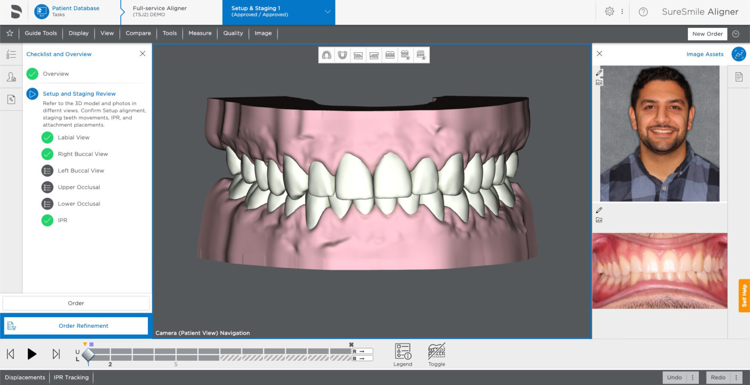 SureSmile Software 7.6 More Options for Individual Treatment Preferences, More Control for