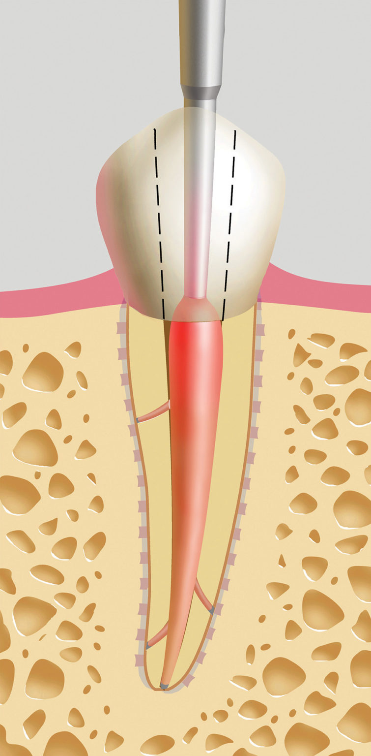 Continuous Wave of Condensation Revisited A New Cordless Obturation System