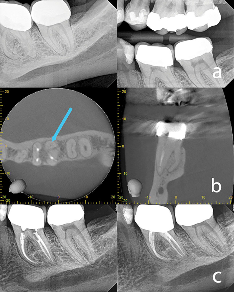 2A. Preoperative Periapical and Bitewing showing no apparent complications. B. Axial and Saggital slices showing a Radix Disto-lingual canal. C. Final periapical image and 12-month recall showing complete healing.