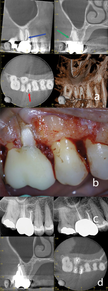 3A. CBVT Images showing the resorptive lesion. B. Clinical Image during surgery showing the repaired defect using Geristore. C. Final periapical image, and 1-year recall showing complete healing. D. 2.5 year recall CBVT Images showing complete healing. 4A. Pre-operative periapical radiograph. B. Clinical photo showing periodontal probing into the resorptive defect. C. CBCT Images showing the resorptive defect. D. Clinical photos during surgery showing the defect removed and after placing the restoration. E. Final periapical radiograph. 3