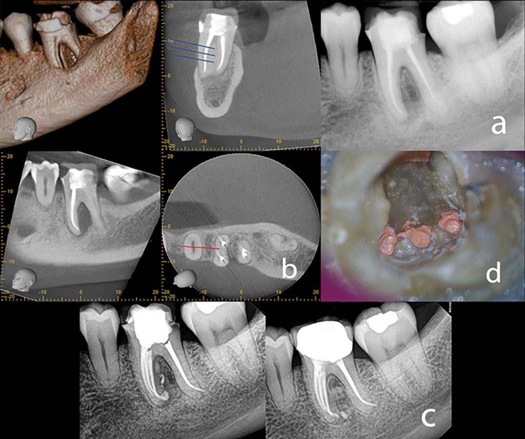 1A. Preoperative radiograph with a clinical diagnosis (AAE Guidelines) of Previous Treatment/Chronic Apical Abscess. B. CBVT Images showing the radiolucent entity, and potential additional anatomy. C. Final and 18-month recall showing complete healing. D. Clinical photo showing 3 mesial canals obturated.