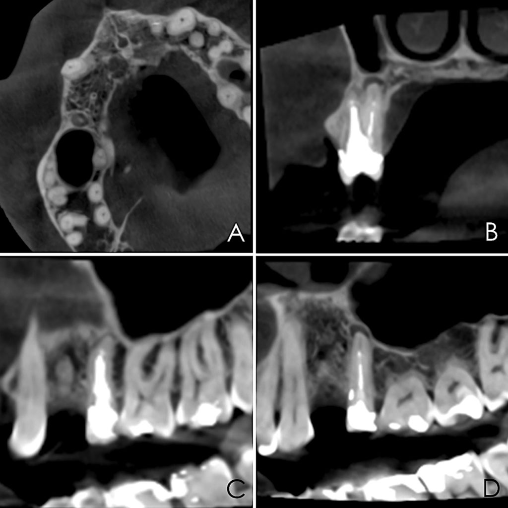 1. Pre-surgical cbCT. A. Axial view. B. Coronal view. C. Sagittal view of buccal root. D. Sagittal view of palatal root. 