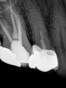 Pre-operative periapical radiograph of maxillary right second premolar after an previous emergency root canal treatment
