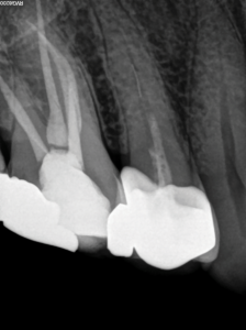  Pre-operative periapical radiograph of maxillary right second premolar after an previous emergency root canal treatment