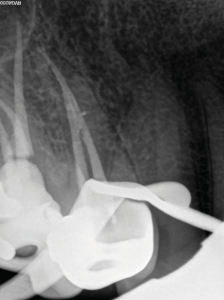 Post-operative result after obturation