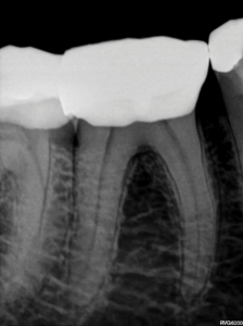 Pre-operative periapical radiograph of mandibular right first molar