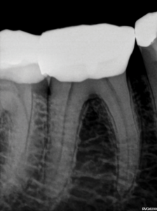  Pre-operative periapical radiograph of mandibular right first molar