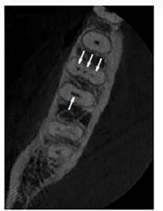 An axial slice of a high resolution CBCT scan revealed four root canal systems (arrows). Three root canals in the mesial root and one large oval root canal in the distal root