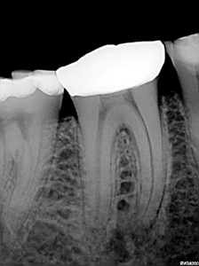 Pre-operative periapical radiograph of mandibular right first molar