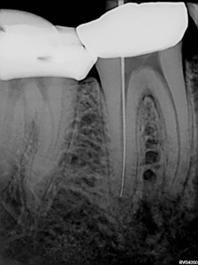 Periapical radiograph to confirm the length determination for the distal root canal;