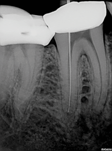 Periapical radiograph to confirm the length determination for the distal root canal; 