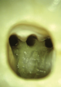Magnified view of the pulp chamber floor. Note the large amount of tooth structure that was still intact after root canal preparation with the TruNatomy Small file