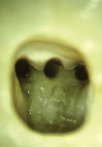  Magnified view of the pulp chamber floor. Note the large amount of tooth structure that was still intact after root canal preparation with the TruNatomy Small file