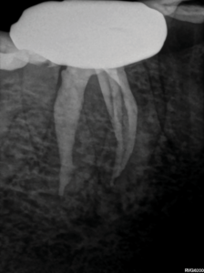 Parallel view of the obturation result. Note the maximum preservation of the root structure in the peri-cervical region of the mesial and distal root canal systems