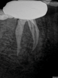  Parallel view of the obturation result. Note the maximum preservation of the root structure in the peri-cervical region of the mesial and distal root canal systems