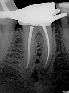 Mesio-angulated view shows the full extend of the lateral anatomy that was cleaned and obturated