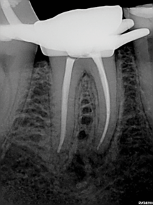  Mesio-angulated view shows the full extend of the lateral anatomy that was cleaned and obturated