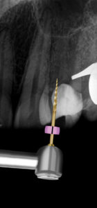 Pre-operative periapical radiograph of maxillary left first premolar and orifice modification with the TruNatomy Orifice Modifier