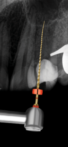 Root canal preparation with the TruNatomy Prime instrument