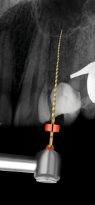  Root canal preparation with the TruNatomy Prime instrument