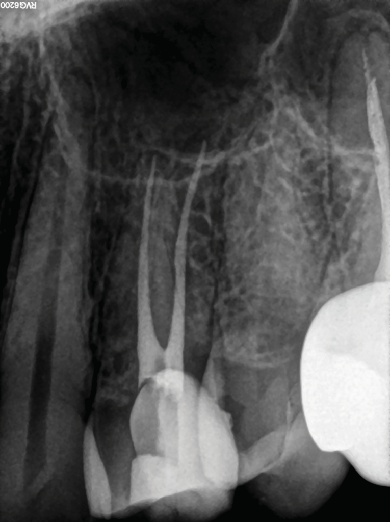 Minimally Invasive Endodontics Using a New SingleFile Rotary System Oral Health Group