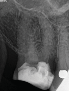 Pre-operative periapical radiograph of maxillary right first molar
