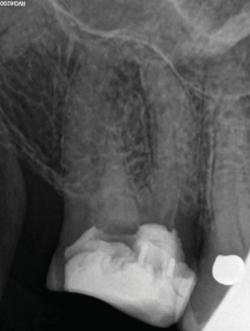  Pre-operative periapical radiograph of maxillary right first molar