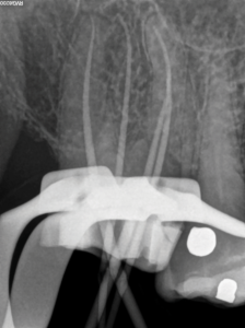 Conefit periapical radiograph