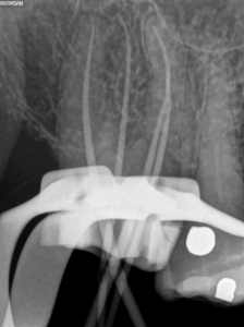  Conefit periapical radiograph