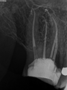 Post-operative result after obturation, fiber post placement and composite core.