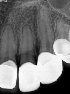 Length determination periapical radiograph;