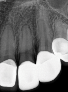  Length determination periapical radiograph; 