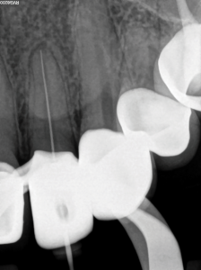 Conefit periapical radiograph