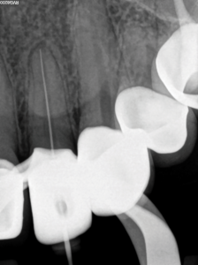  Conefit periapical radiograph