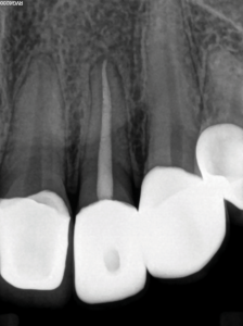 Post-operative result after obturation.