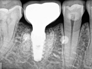 Radiograph taken 3 months following implant placement at restoration to verify seating of the restorative components into the implant. 