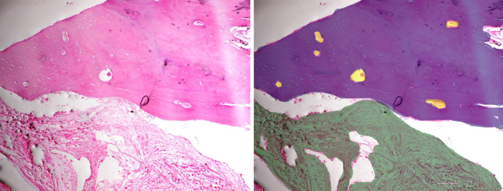 Histopathology of bone sample showing new bone formation (blue on right), with osteocytes in osteocytic lacunae (yellow on right) in a fibrocellular stroma (green on right).