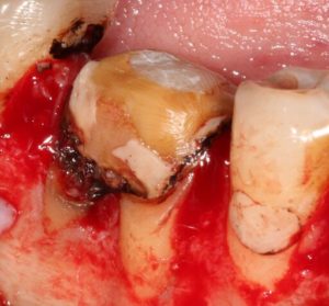 . Following flap elevation, it is apparent the tooth is non-restorable due to caries breakdown.