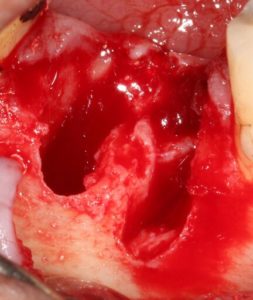 Following extraction of the tooth, insufficient remaining alveolar process remains to allow immediate implant placement and socket grafting will be required prior to implant placement.