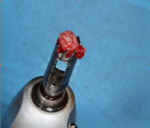 Bone sample taken from the site following flapping with a trephine for histological analysis.