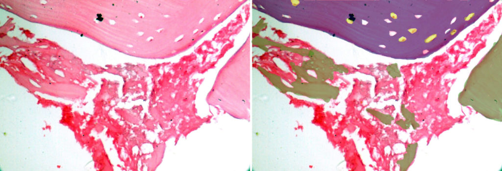 Mature bone (blue on right) with osteocytes in osteocytic lacunae (yellow on right) and new bone formation in a fibrocellular stroma (green on right)