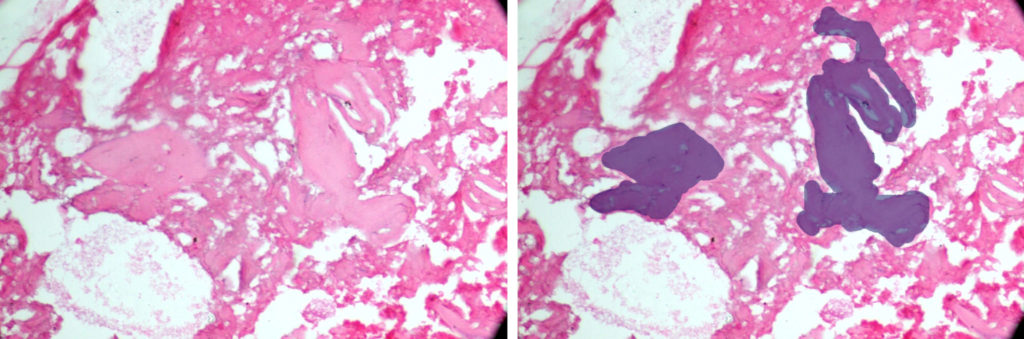 Histopathology of bone sample showing mature bone (blue area on right) with osteocytes in osteocytic lacunae new bone formation in a fibrocellular stroma.