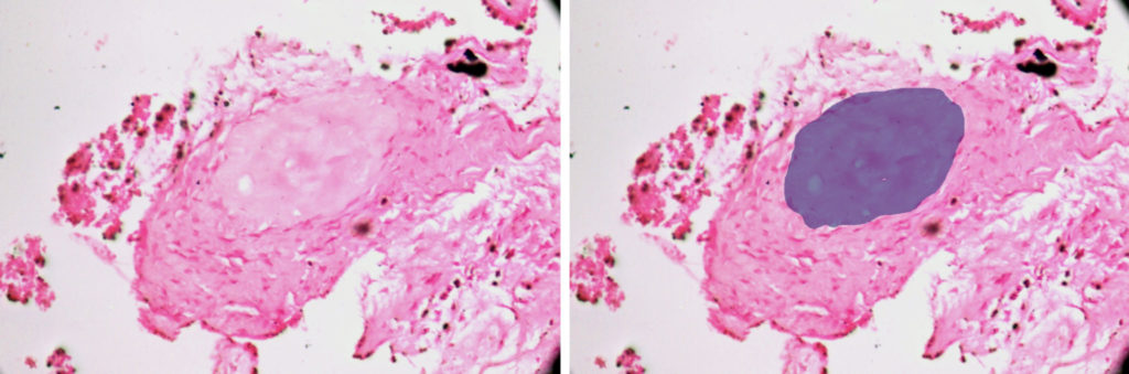 New bone formation in a fibrocellular background stroma (blue on right).