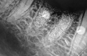 . Radiograph at 21 weeks post socket grafting demonstrating socket fill with granularity present from the Ti-Oss particles noted.